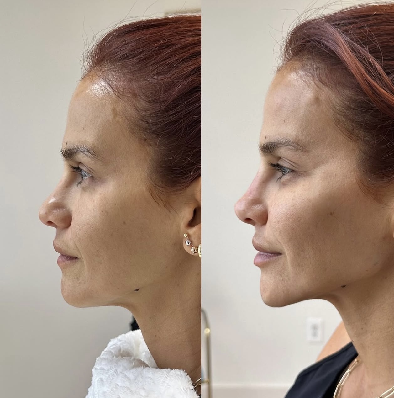 Patient 8 real result for rhinoplasty