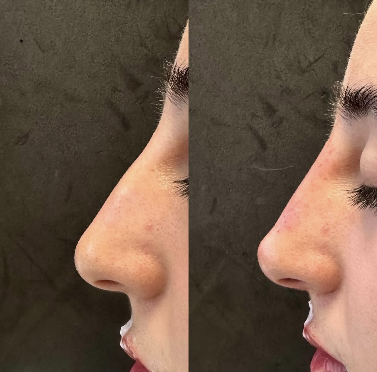 Patient 7 real result for rhinoplasty