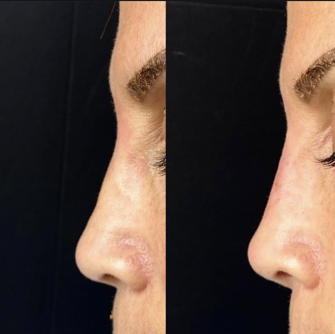 Patient 6 real result for rhinoplasty