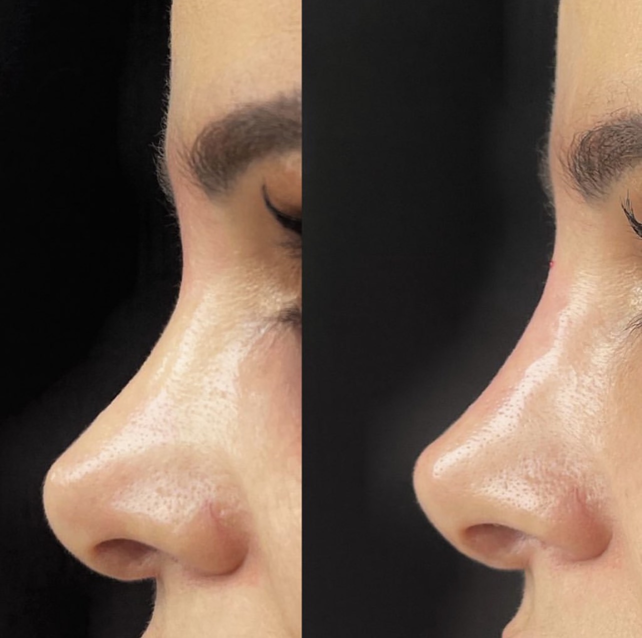 Patient 5 real result for rhinoplasty