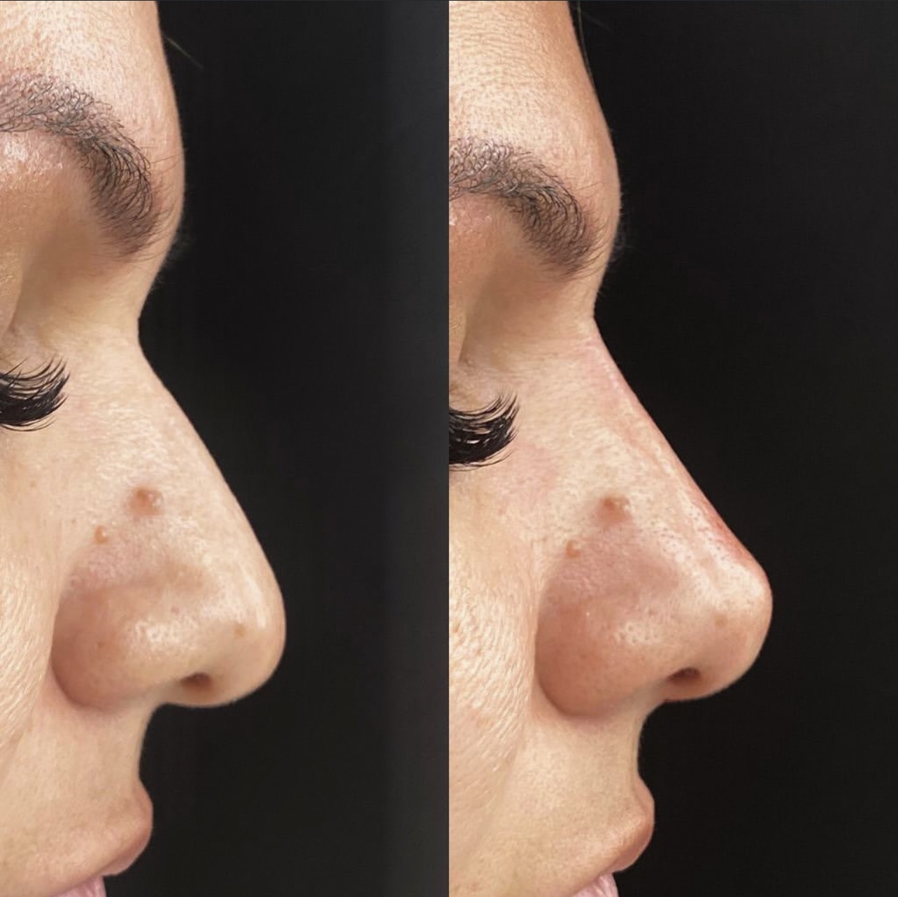 Patient 4 real result for rhinoplasty