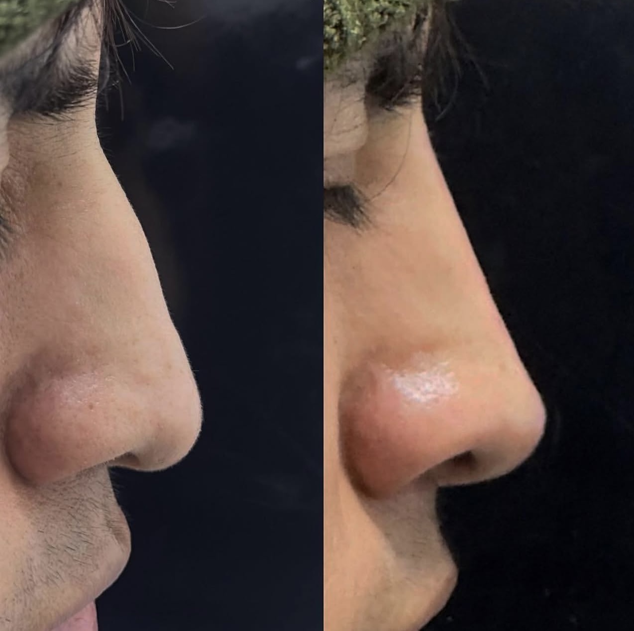 Patient 3 real result for rhinoplasty
