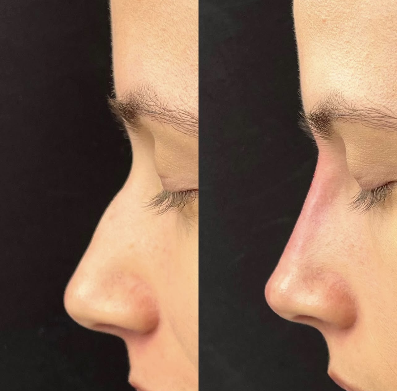 Patient 2 real result for rhinoplasty