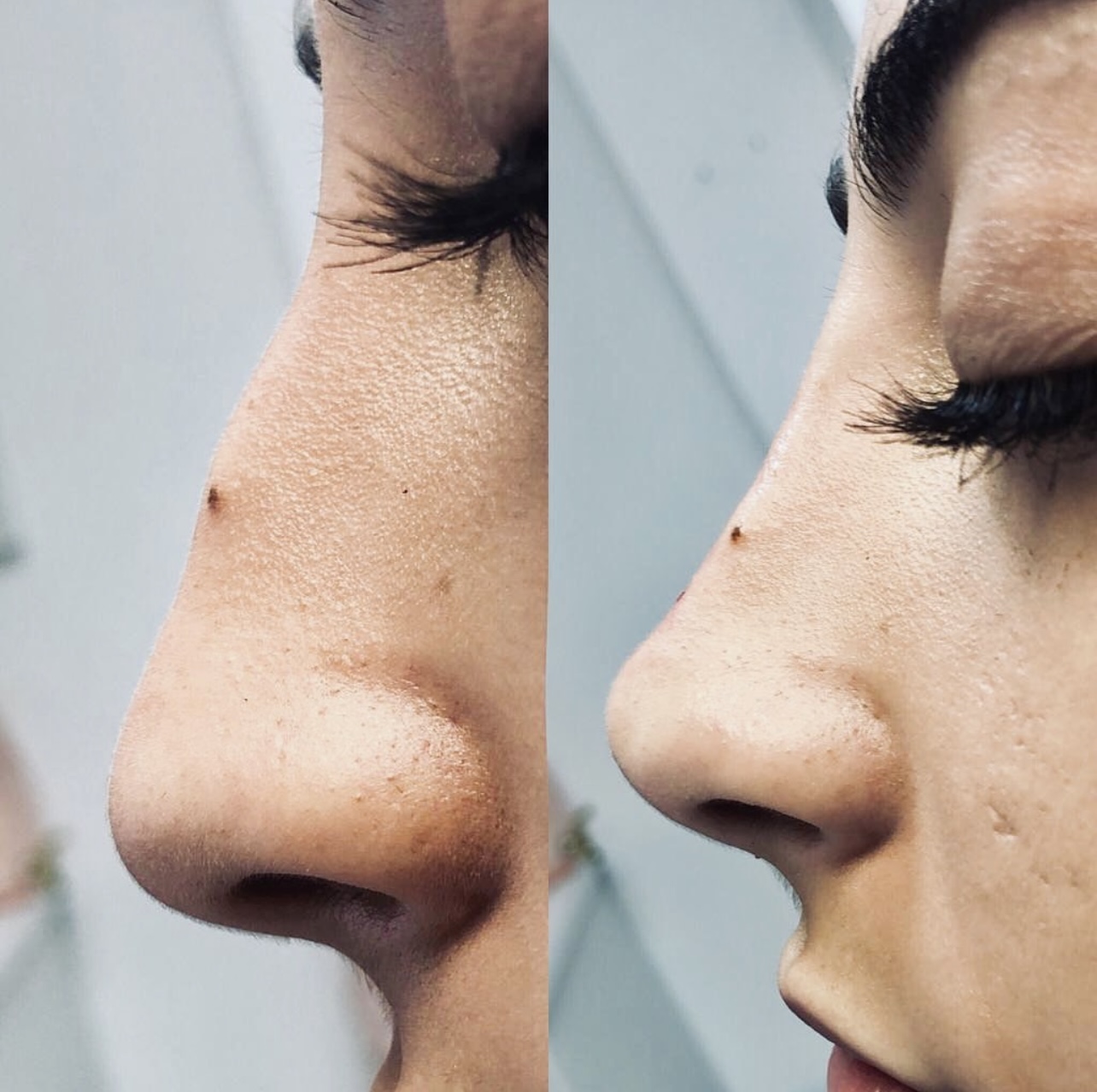 Patient 1 real result for rhinoplasty