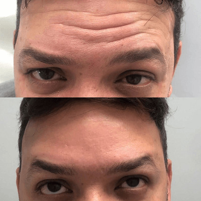 Patient 15 real result for toxina botulinica
