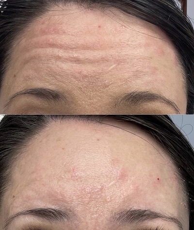 Patient 14 real result for toxina botulinica