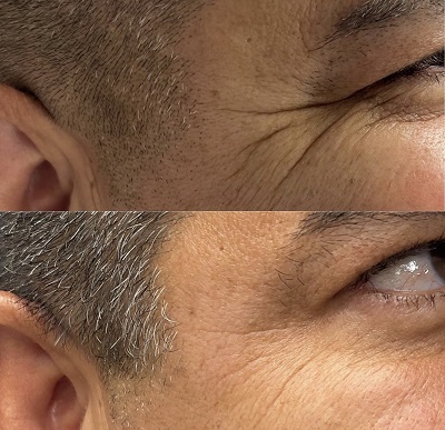 Patient 13 real result for toxina botulinica