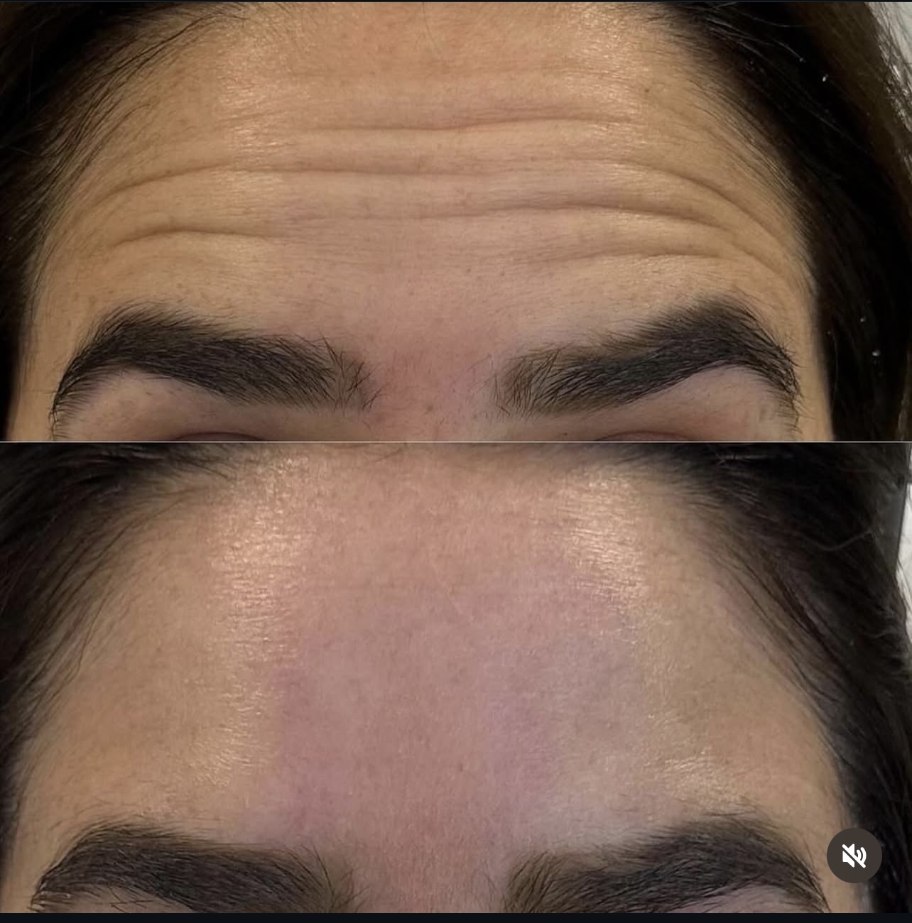 Patient 12 real result for toxina botulinica