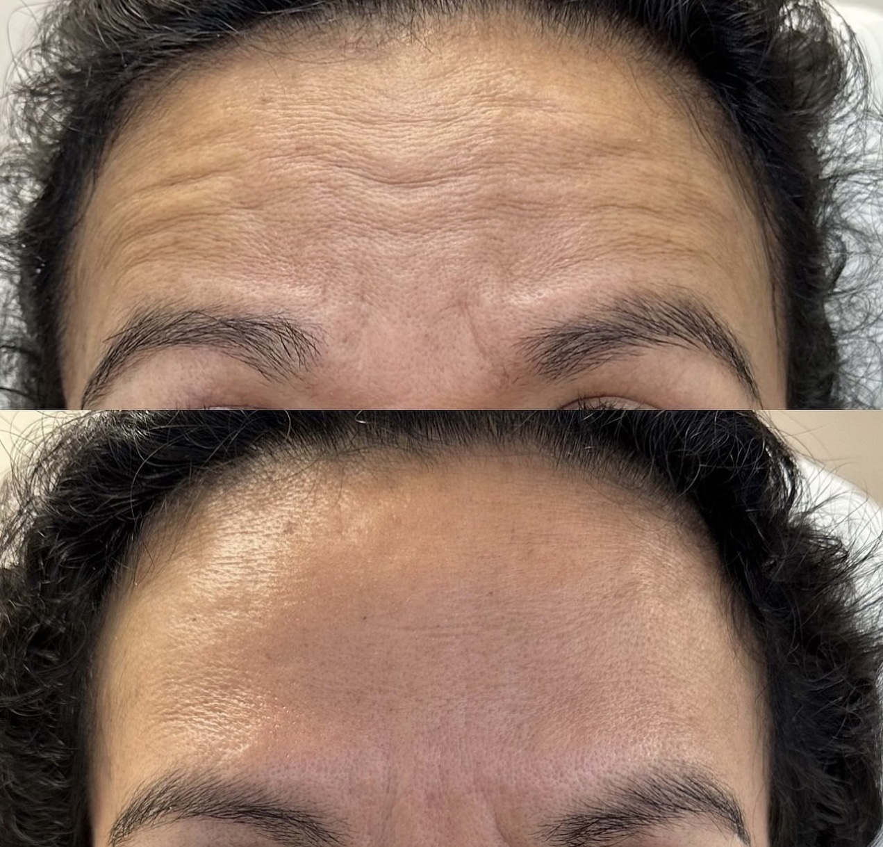 Patient 11 real result for toxina botulinica