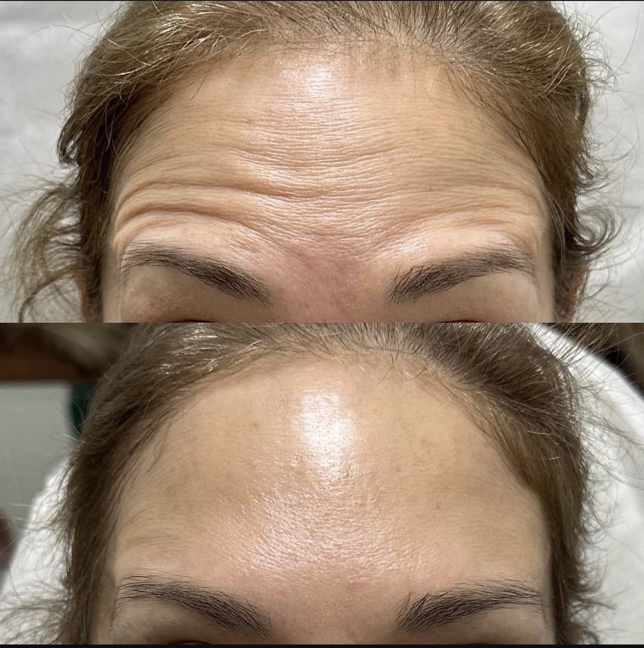 Patient 10 real result for toxina botulinica