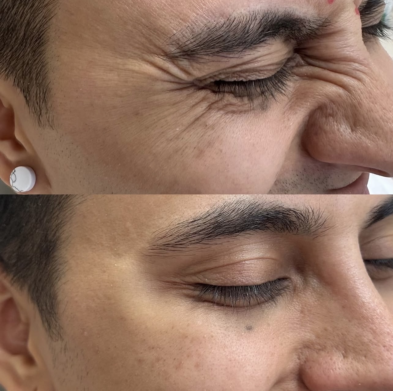 Patient 9 real result for toxina botulinica
