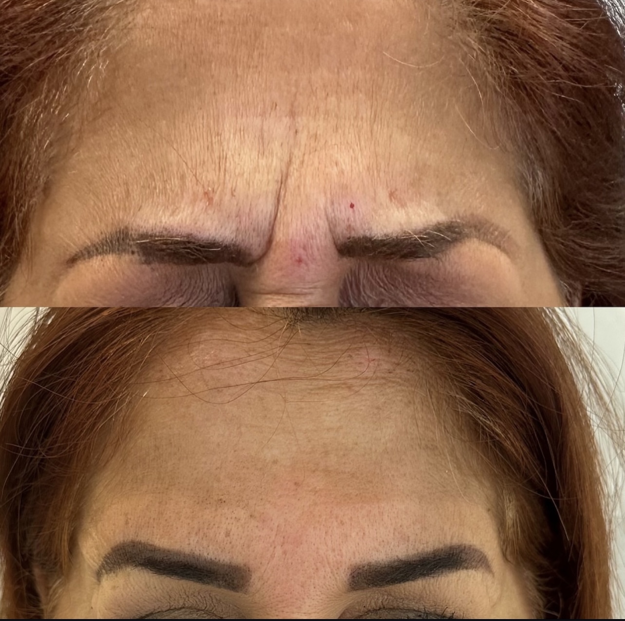 Patient 8 real result for toxina botulinica