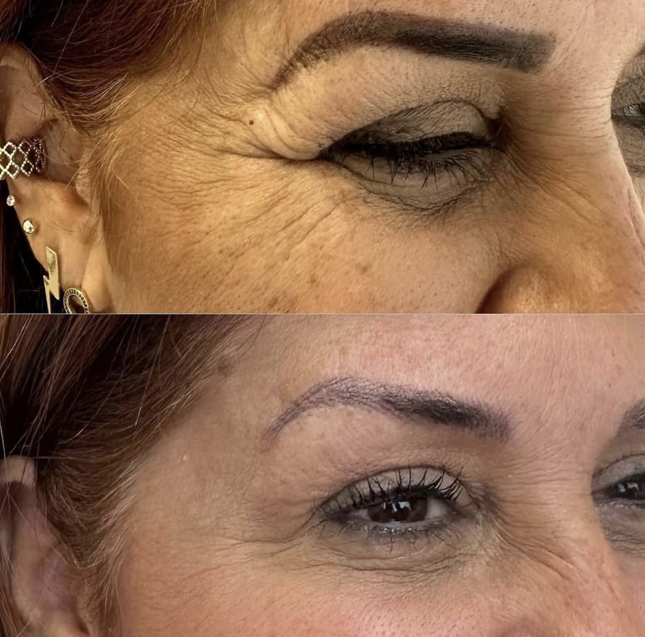 Patient 7 real result for toxina botulinica