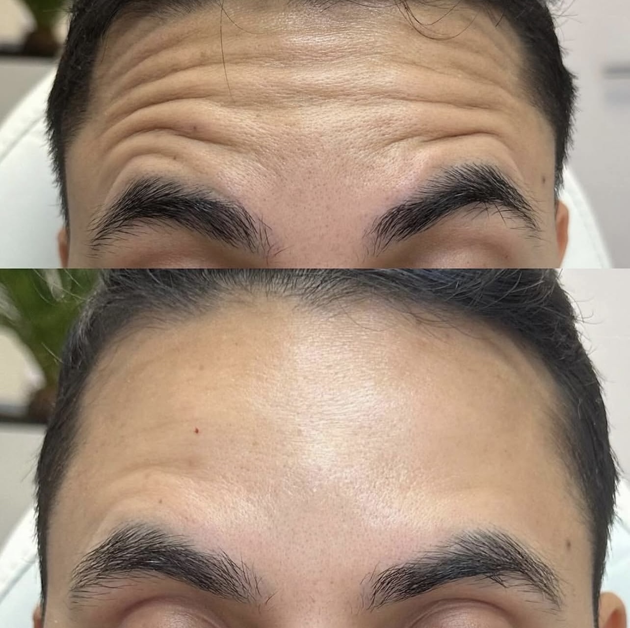 Patient 6 real result for toxina botulinica