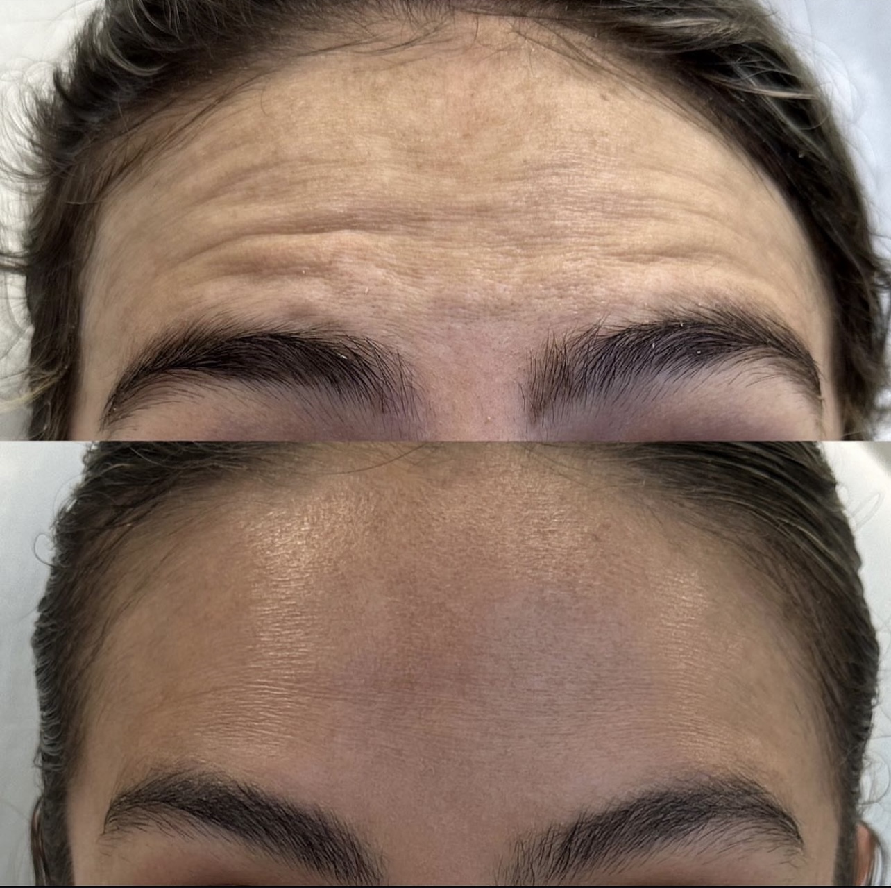 Patient 5 real result for toxina botulinica