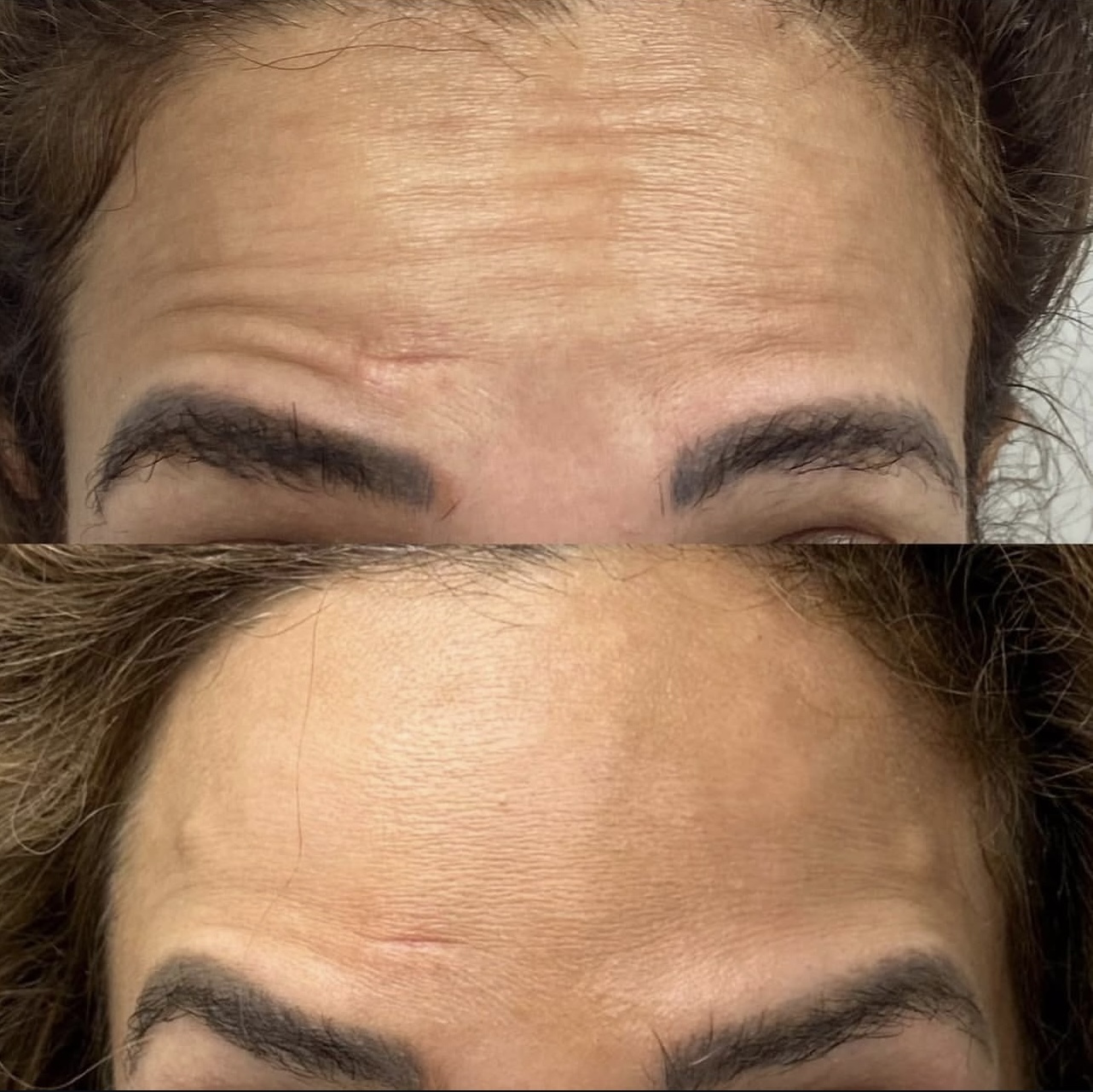 Patient 4 real result for toxina botulinica