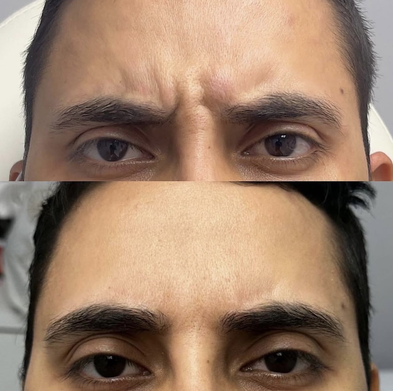 Patient 3 real result for toxina botulinica