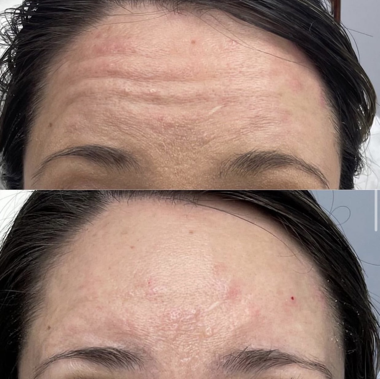 Patient 2 real result for toxina botulinica