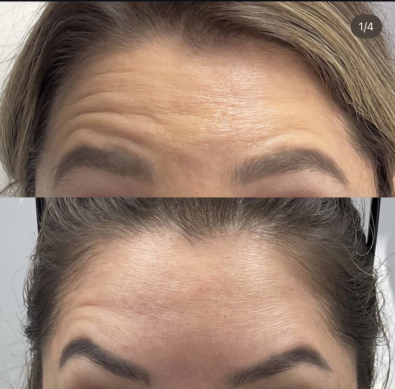Patient 1 real result for toxina botulinica