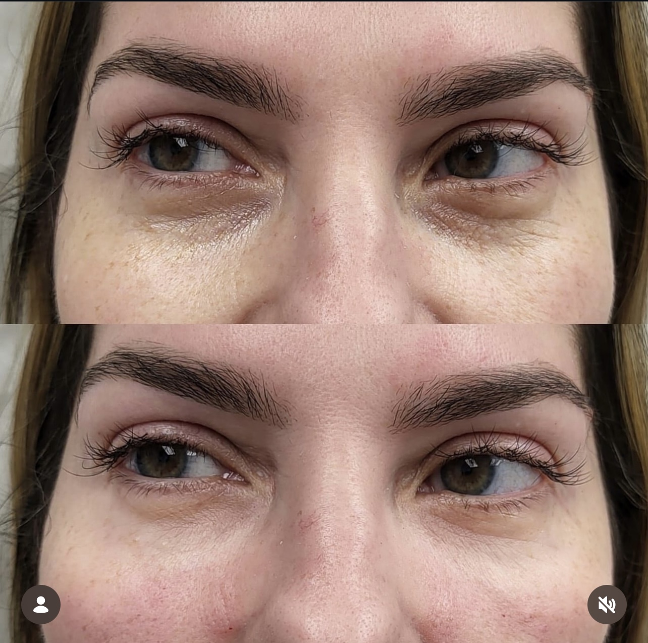 Patient 12 real result for under eye correction