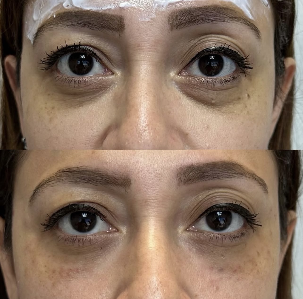 Patient 11 real result for under eye correction