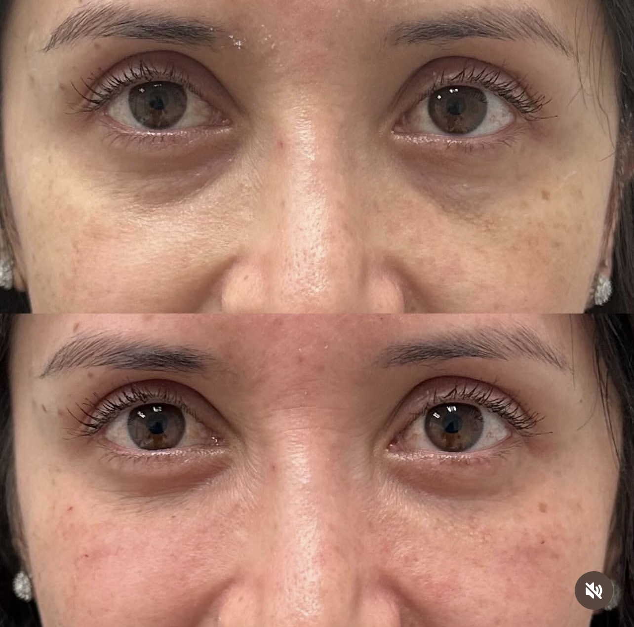 Patient 10 real result for under eye correction