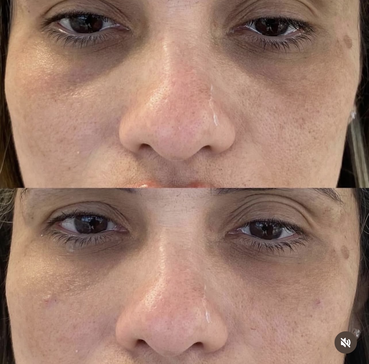 Patient 9 real result for under eye correction