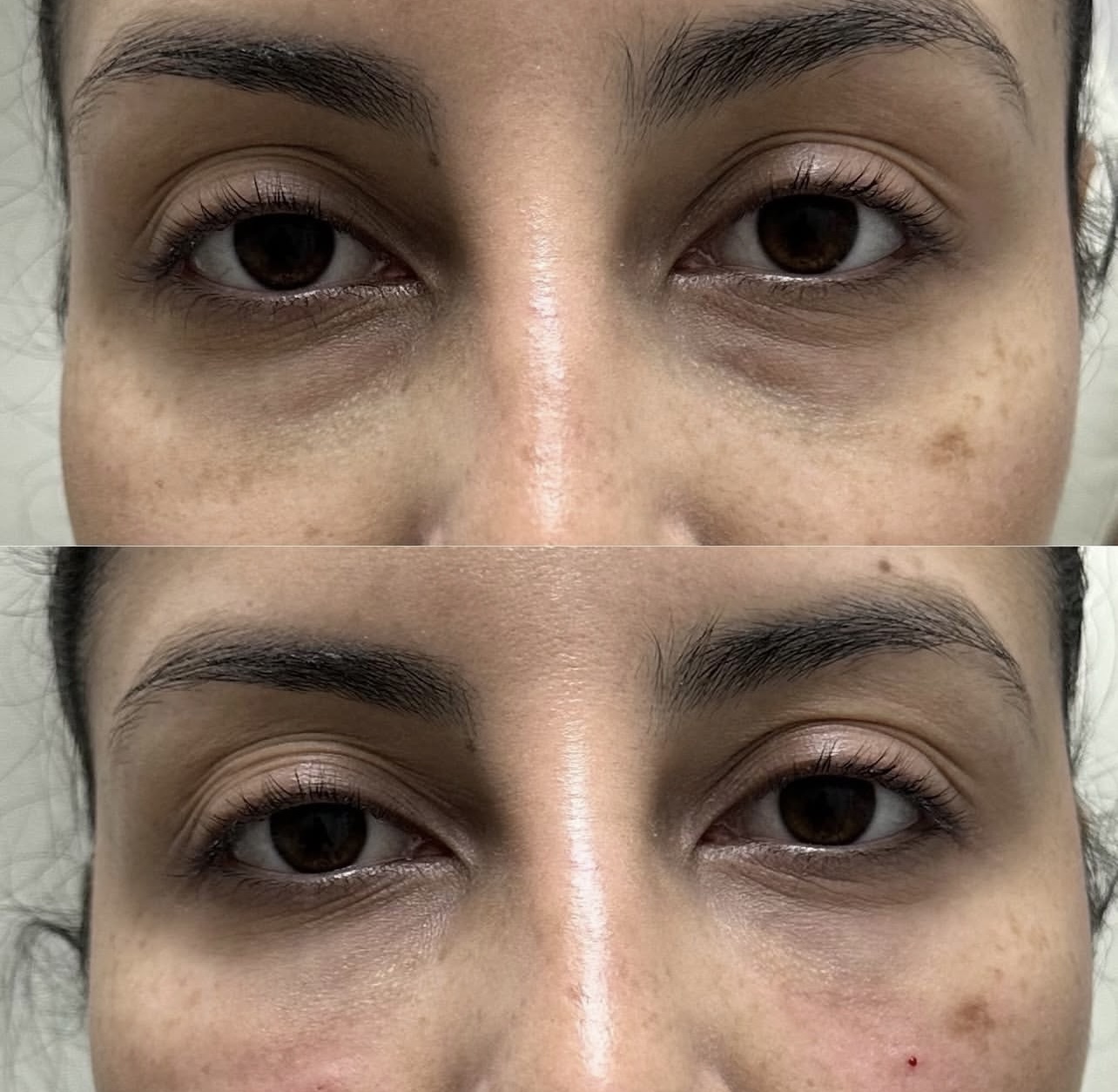 Patient 8 real result for under eye correction