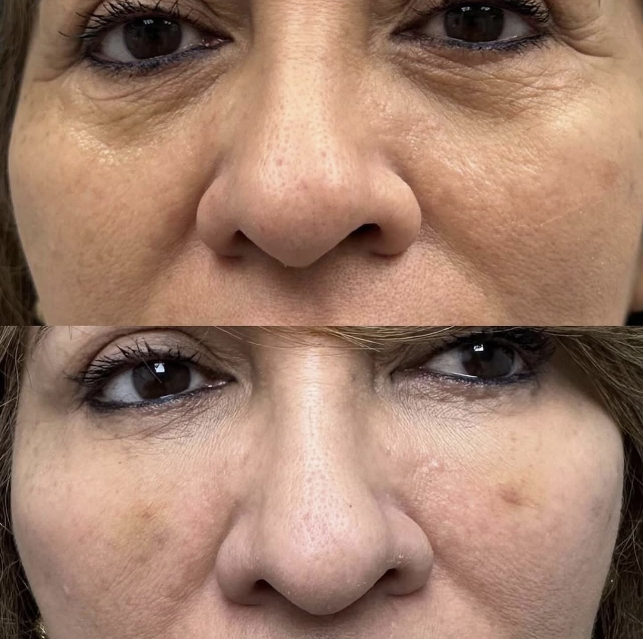 Patient 7 real result for under eye correction