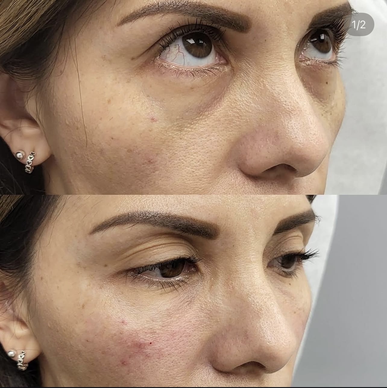Patient 6 real result for under eye correction