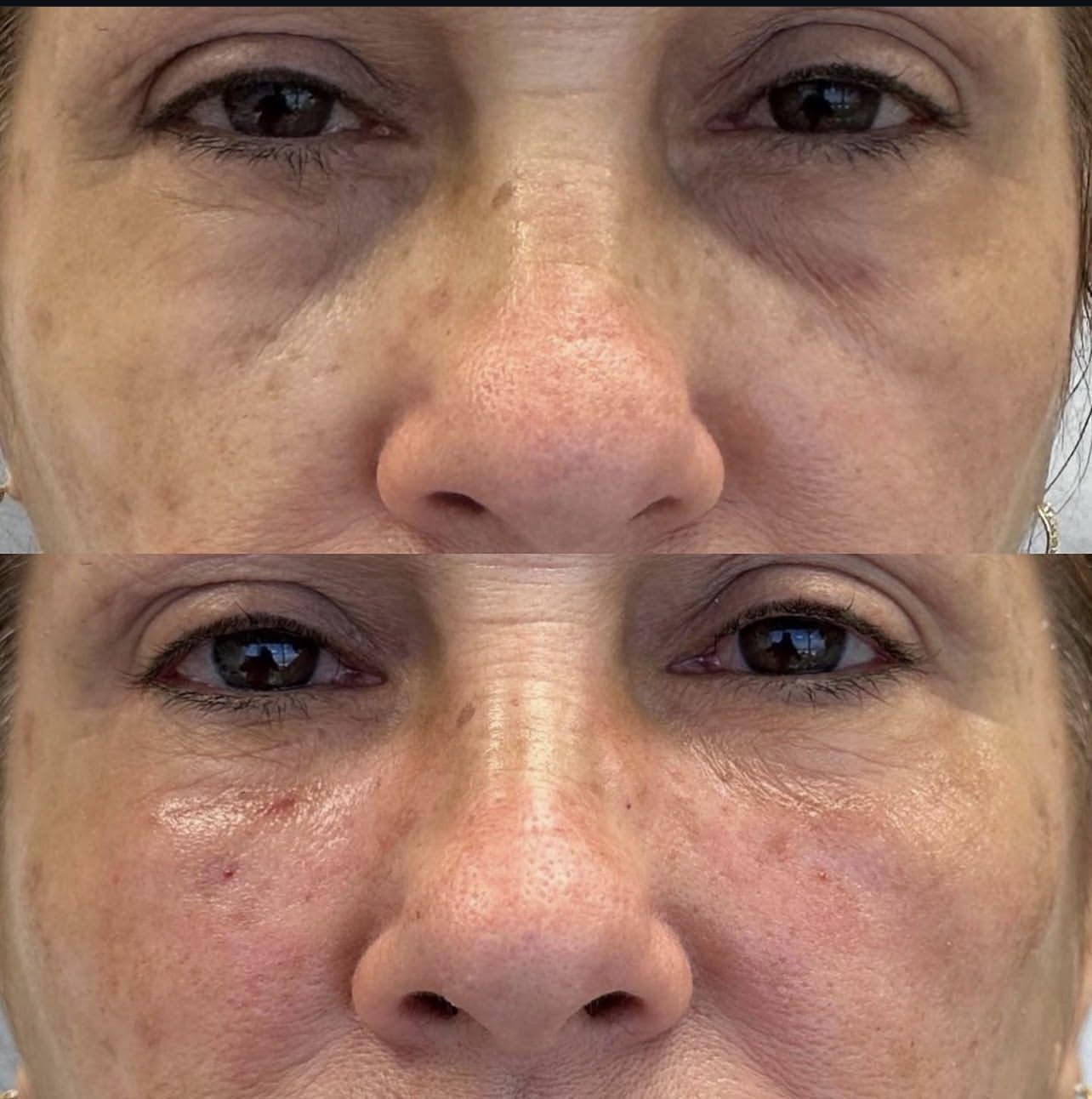 Patient 5 real result for under eye correction