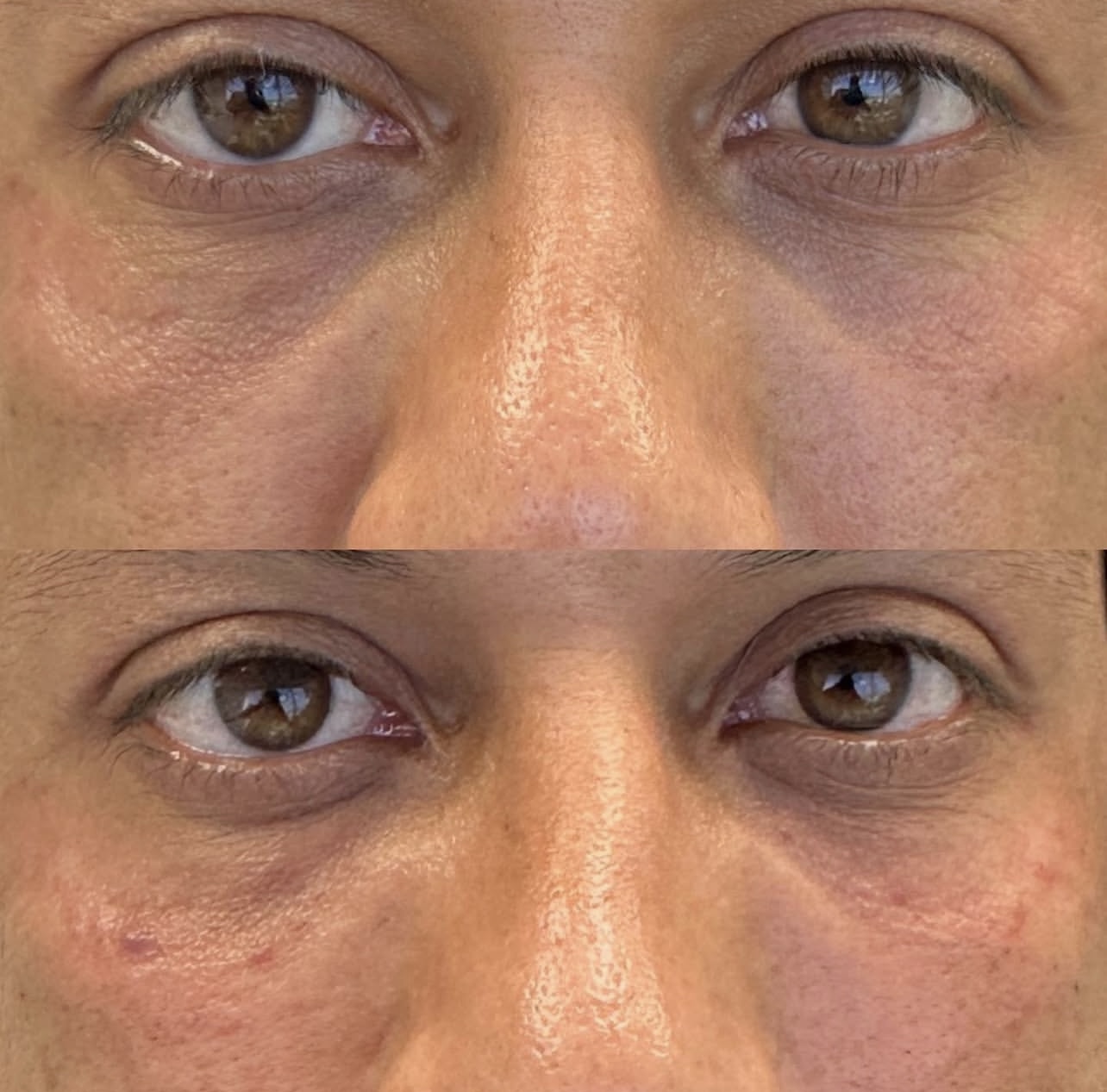 Patient 4 real result for under eye correction