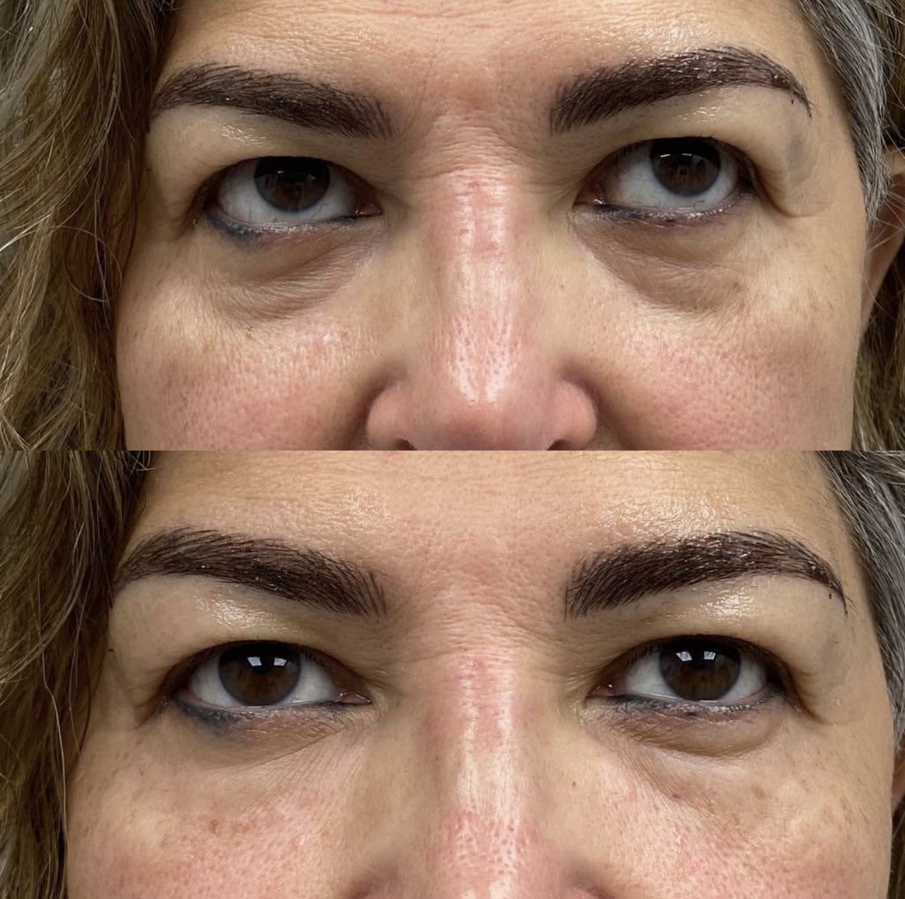Patient 3 real result for under eye correction