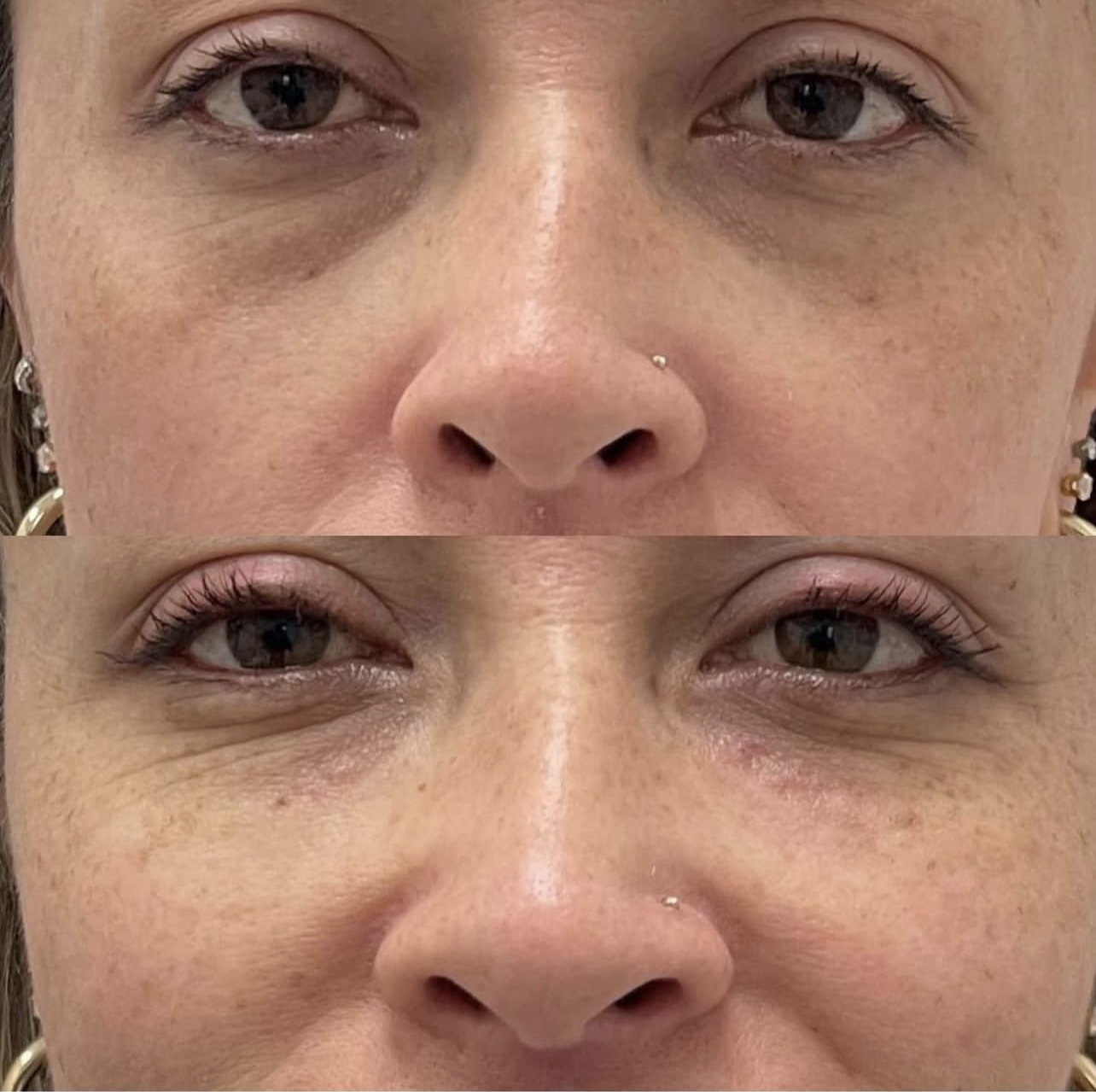 Patient 2 real result for under eye correction