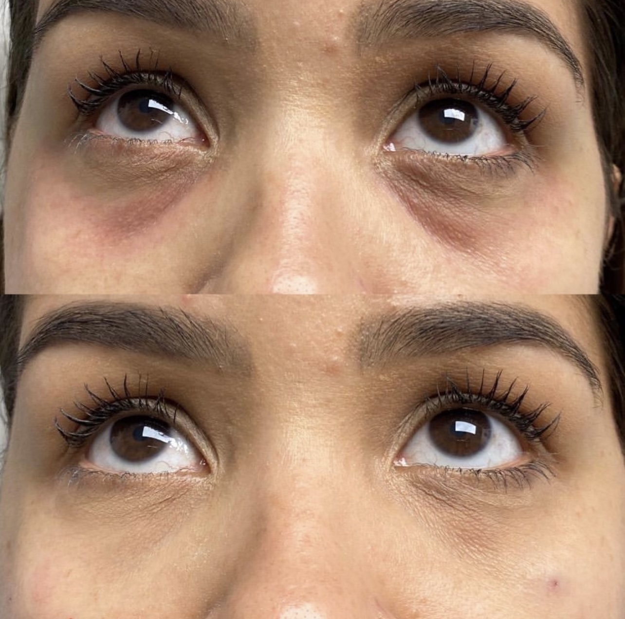 Patient 1 real result for under eye correction