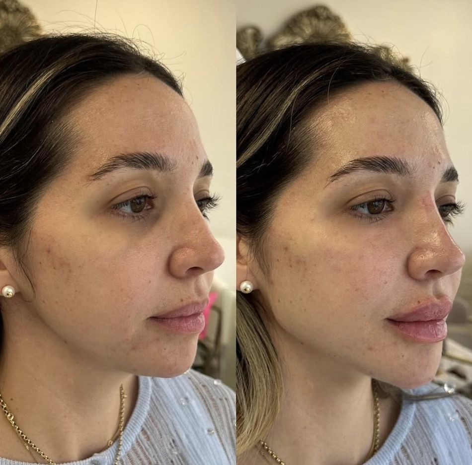 Ozempic Face in Miami: How to Fix It | Liscano Clinic