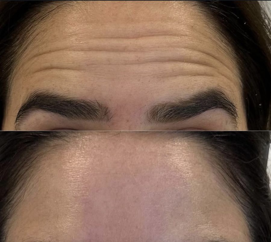 Real botulinum toxin before and after result on forehead lines at Liscano Clinic in Miami