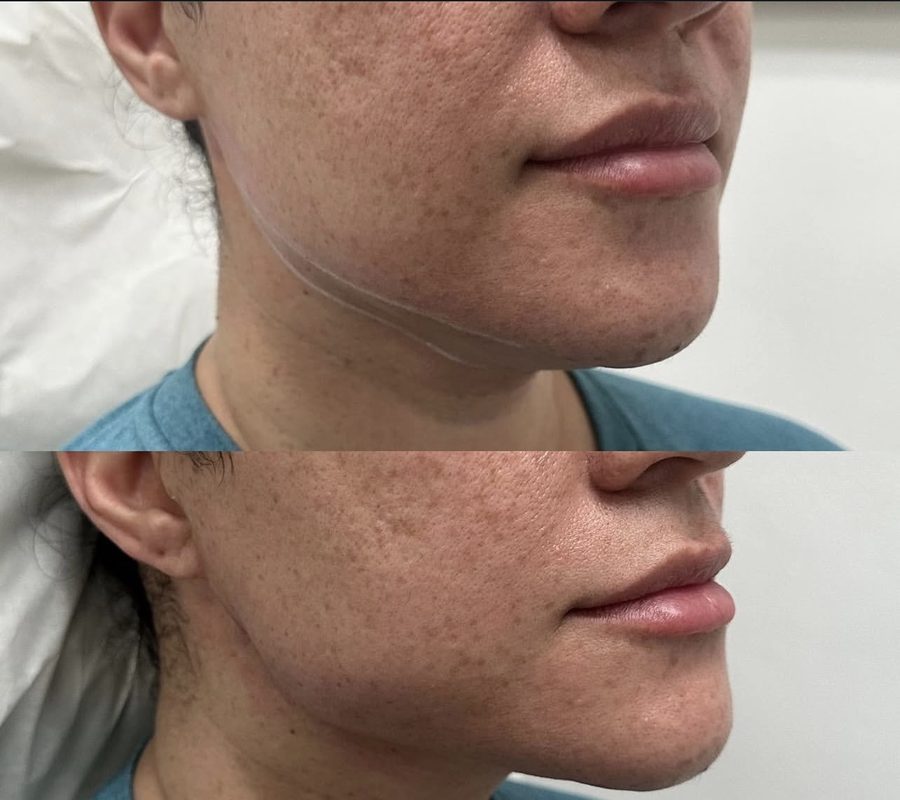 Real Jawline Definition before and after result at Liscano Clinic in Miami