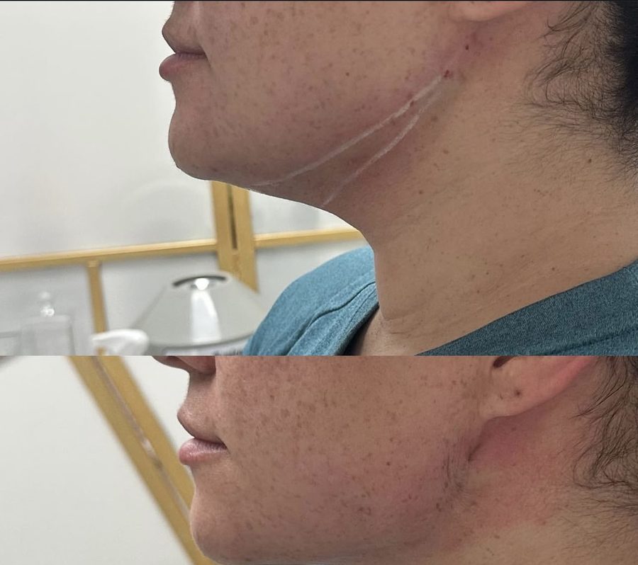 Real Kybella before and after result at Liscano Clinic in Miami
