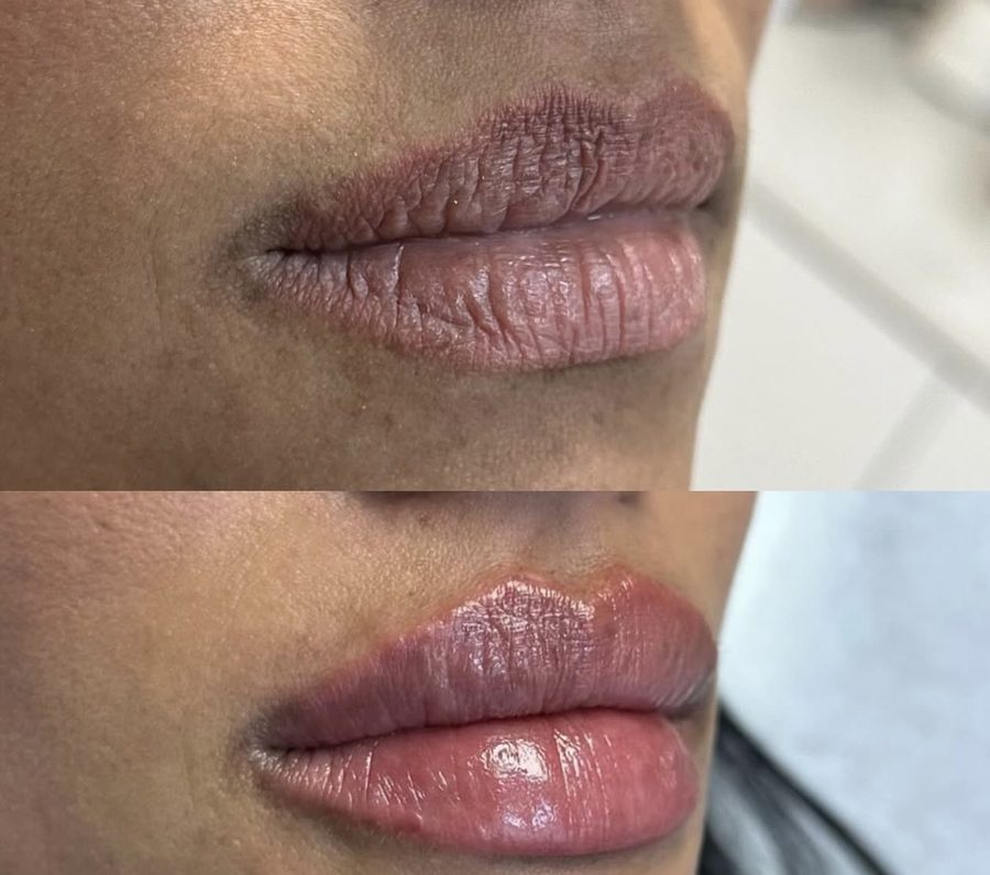 Real lip augmentation before and after result at Liscano Clinic in Miami