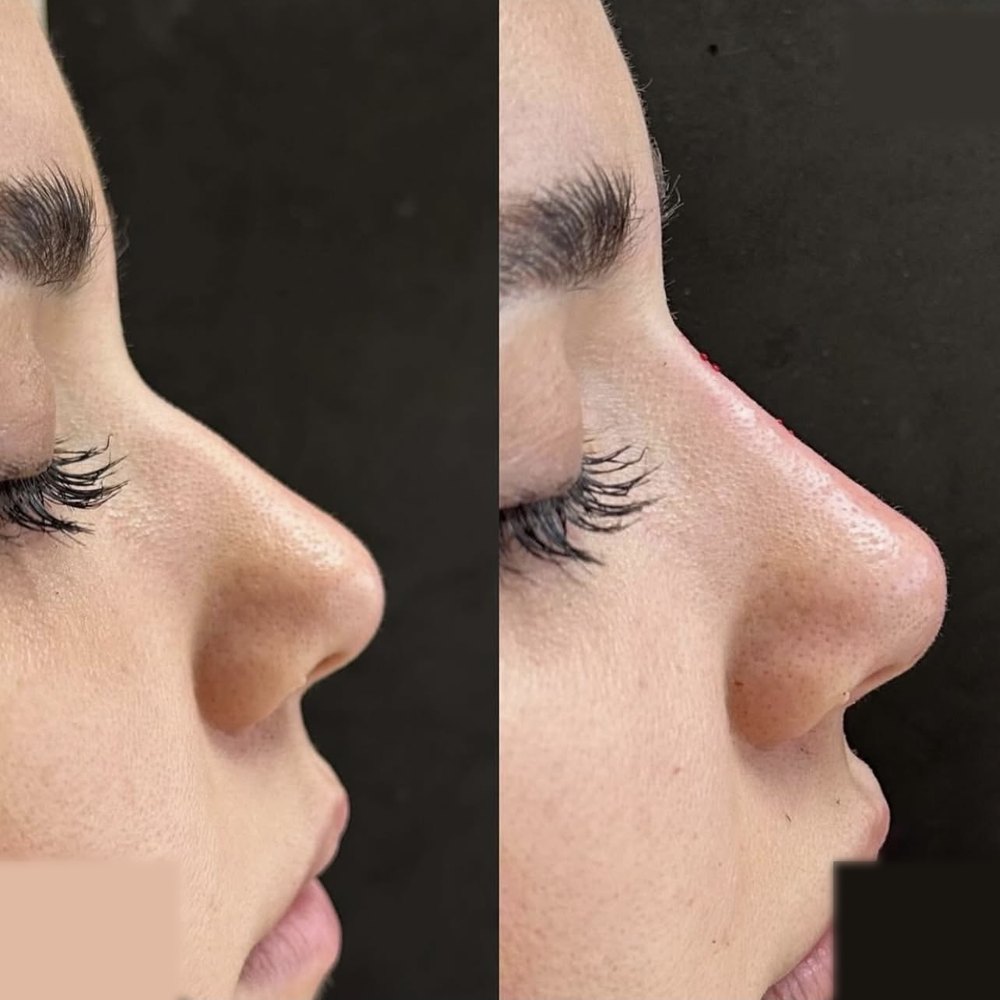Real non-surgical rhinoplasty before and after result on a Liscano Clinic patient in Miami