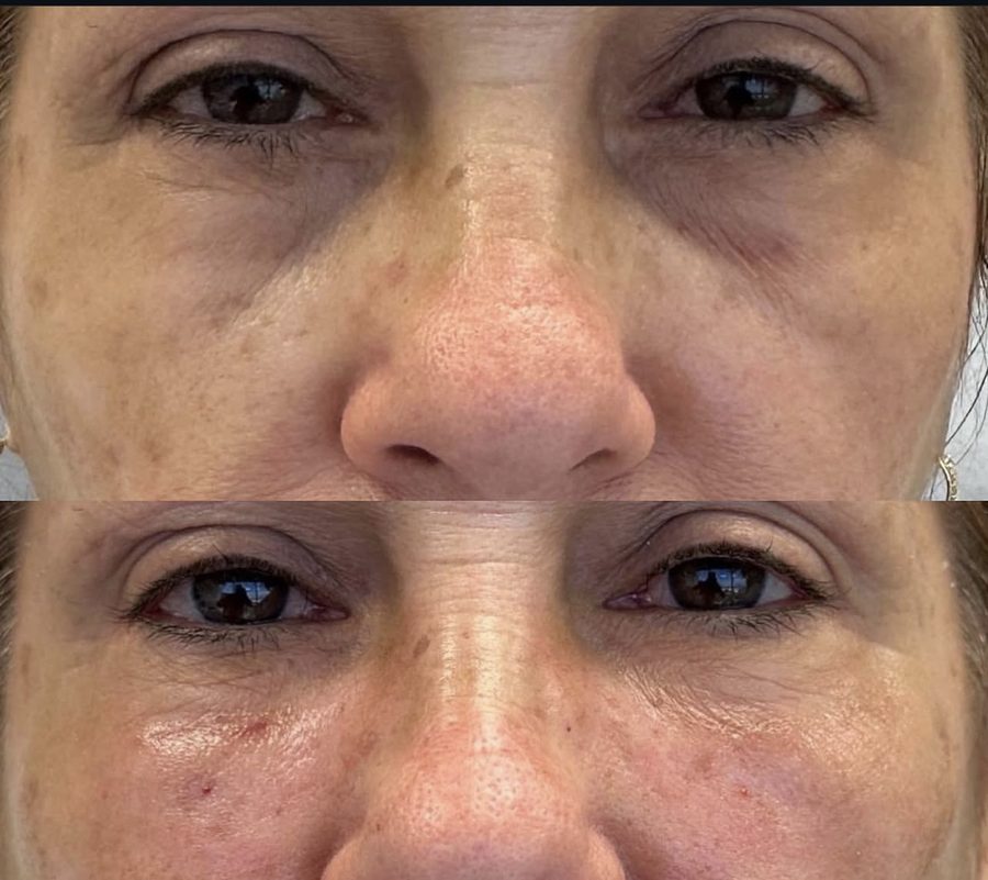 Real Under-Eye Correction before and after result at Liscano Clinic in Miami